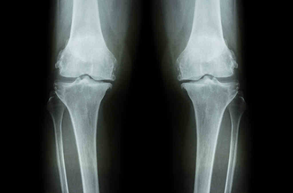 Röntgenbild beider Knie von vorne. Der Gelenkspalt, und damit der Knorpel, ist auf der Innenseite der Kniegelenke deutlich schmäler. Ausserdem sieht man Knochenanlagerungen. Typische Zeichen für eine Gonarthrose.