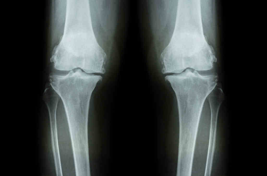 Röntgenbild beider Knie von vorne. Der Gelenkspalt, und damit der Knorpel, ist auf der Innenseite der Kniegelenke deutlich schmäler. Ausserdem sieht man Knochenanlagerungen. Typische Zeichen für eine Gonarthrose.
